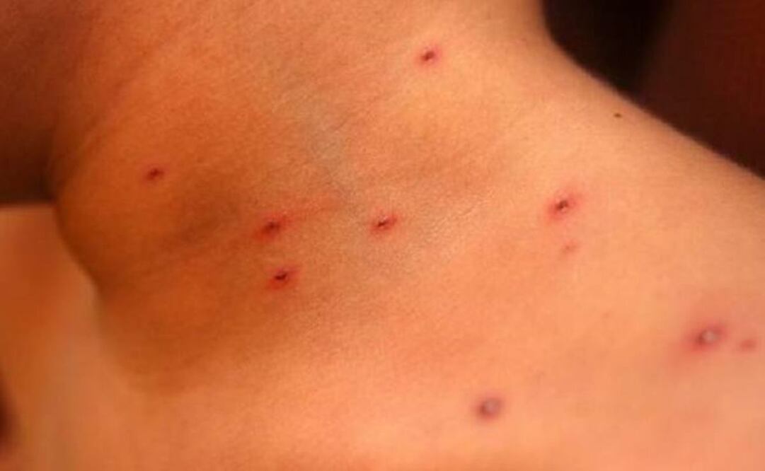 Acumula Oaxaca 615 casos de varicela, 160% más que en 2021; se mantiene vigilancia epidemiológica. Foto: Especial