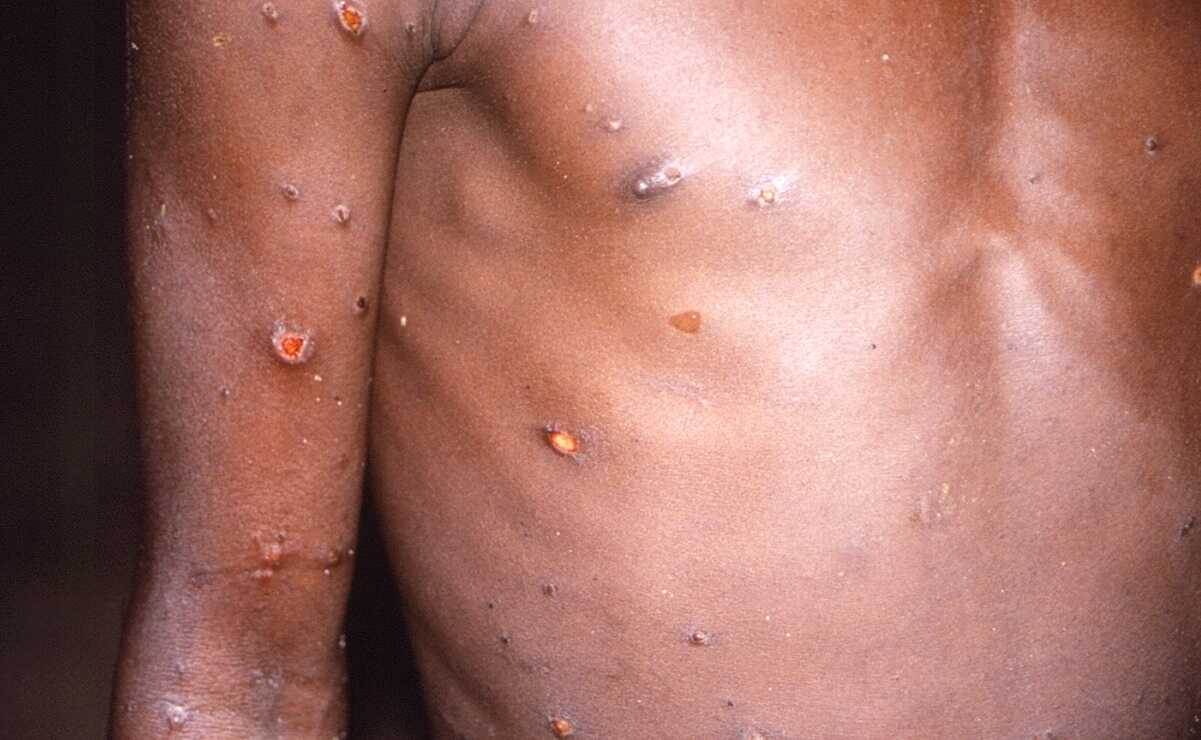 Viruela del mono: Cinco claves para comprender la infección