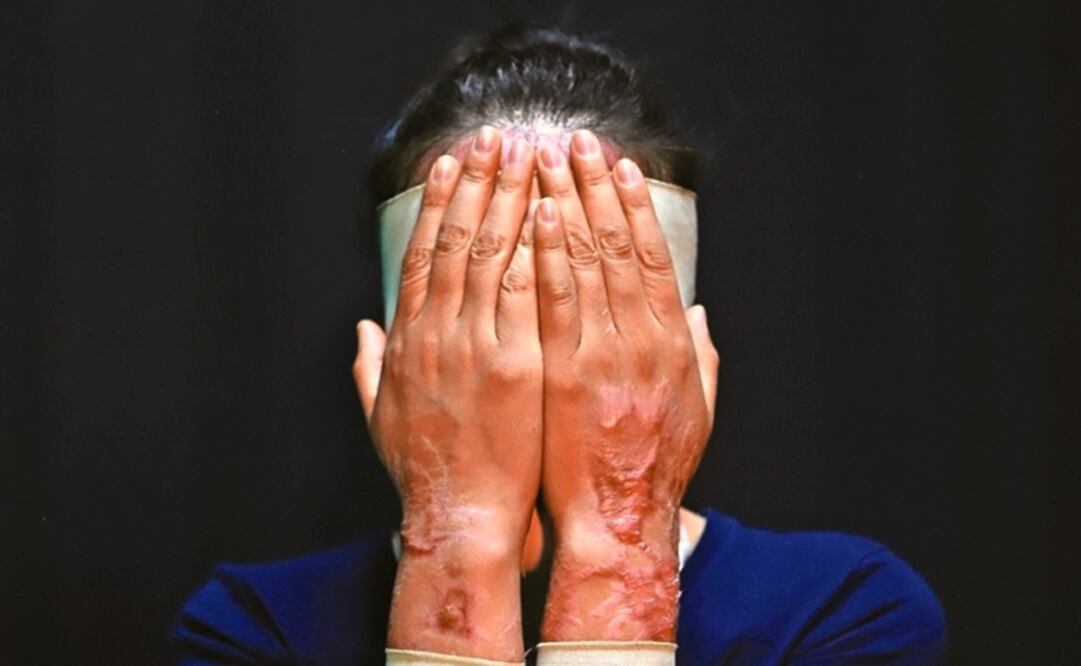 Cámara de Diputados avala tipificar los ataques con ácido como violencia física. Foto: Archivo EL UNIVERSAL