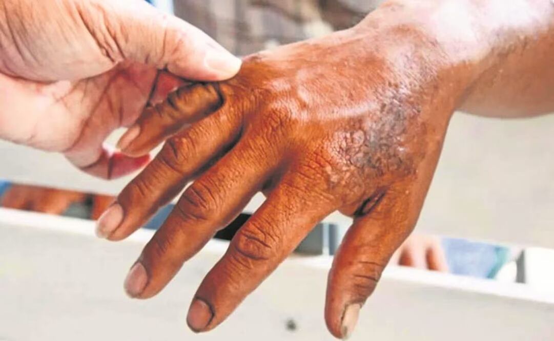 Vigilan 12 municipios de México por casos de lepra, uno está en Oaxaca. Foto: Especial