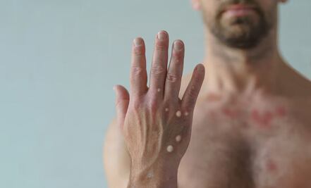 Detectan en Oaxaca posible caso de Viruela del mono en Hospital General de Tuxtepec