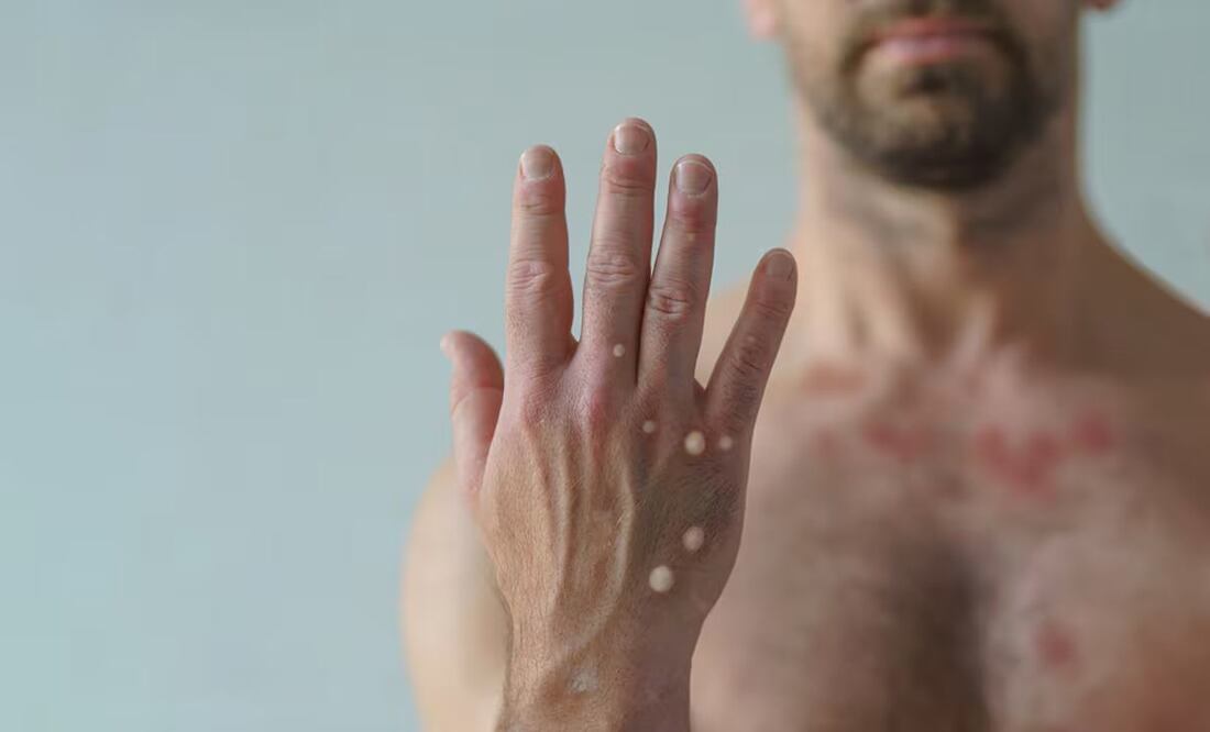 Detectan en Oaxaca posible caso de Viruela del mono en Hospital General de Tuxtepec