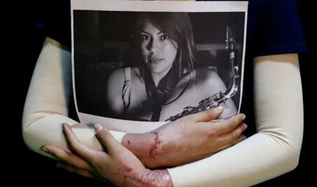 Atrae CNDH caso de saxofonista atacada con ácido en Oaxaca