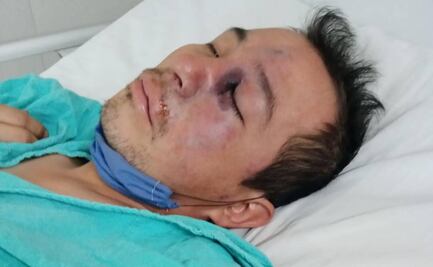 Lo que sabemos del hongo negro, la enfermedad que cobró la vida de un mexicano