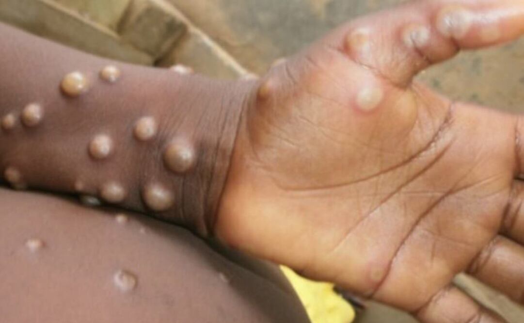 Llaman a fortalecer estas medidas sanitarias ante llegada de viruela del mono; suman dos casos en Oaxaca. Foto: Archivo