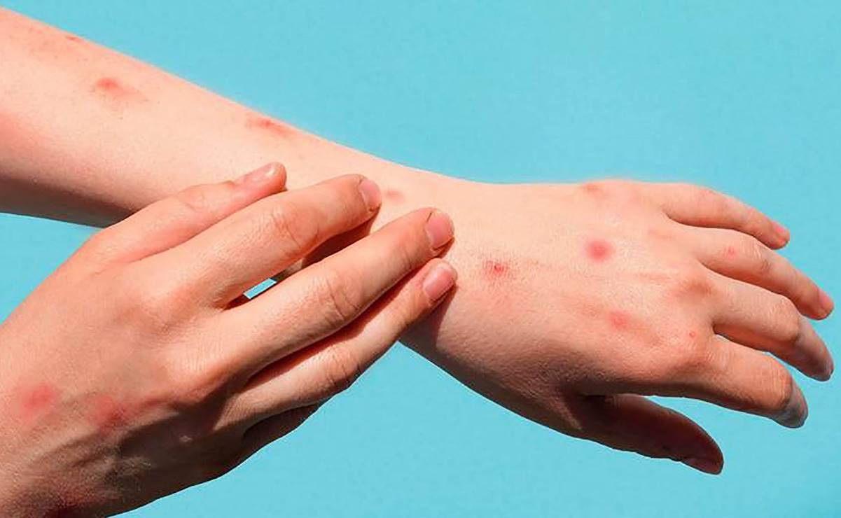 Activan vigilancia epidemiológica tras primer paciente de viruela del mono en Oaxaca; está estable y aislado: SSO