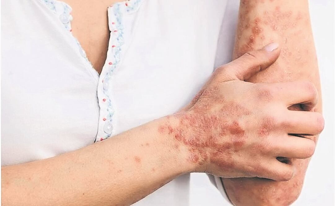 Confirman tercer caso positivo de viruela del mono en Oaxaca, ahora en la región Costa. Foto: Archivo