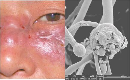 Fallece uno de los dos pacientes de Oaxaca sospechosos de contraer Hongo Negro, tras contagiarse de Covid-19