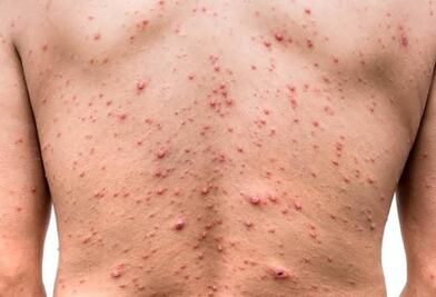 Confirma Oaxaca cuarto caso de viruela del mono; SSO llaman a seguir medidas preventivas