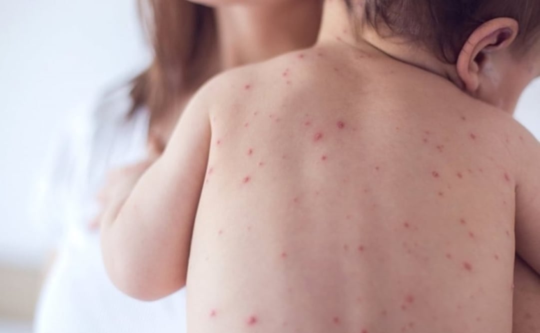 Casos de sarampión en México. Foto: Especial