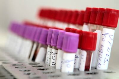 Oaxaca de Juárez, el municipio con más casos de VIH positivo en el estado