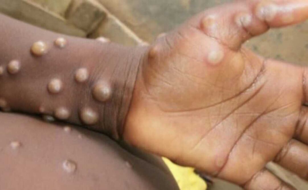 Levanta OMS la emergencia internacional por la viruela del mono. Foto: Archivo EL UNIVERSAL