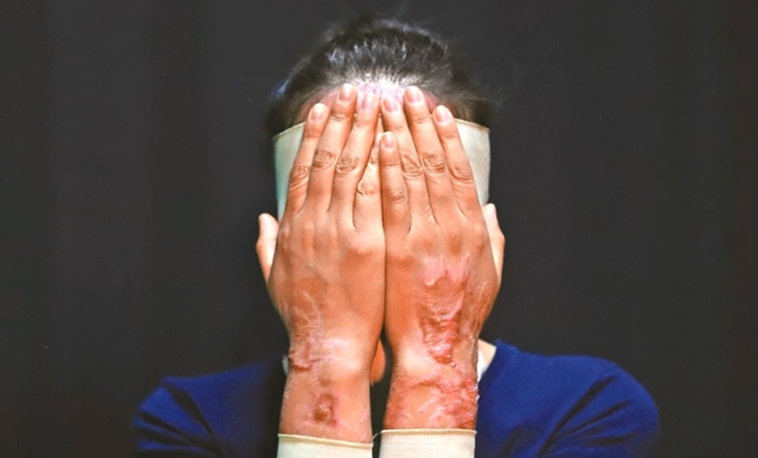 Aprueban en San Lázaro que agresiones con ácido se equiparen como feminicidio en grado de tentativa. Foto: Archivo EL UNIVERSAL