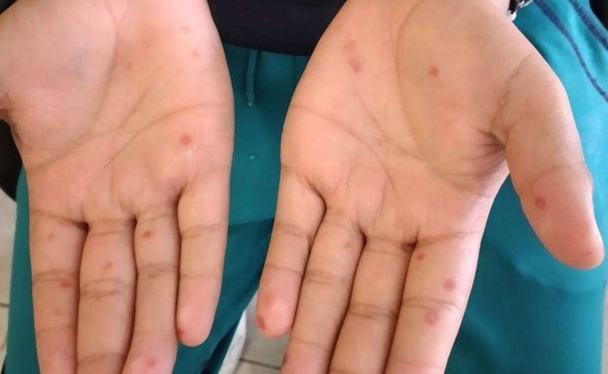 Reinician clases en escuelas de San Pablo Etla tras casos de coxsackie; instalarán filtros sanitarios