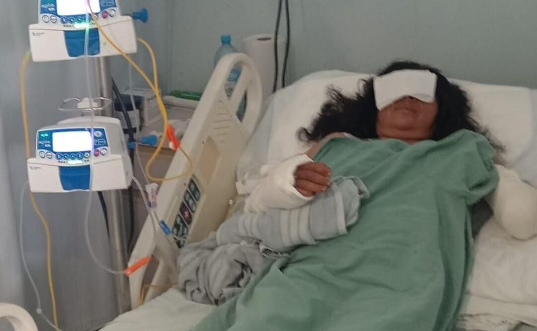 Maratonista de Oaxaca, en riesgo de perder ambos brazos tras ataque de tres perros. Foto: Especial